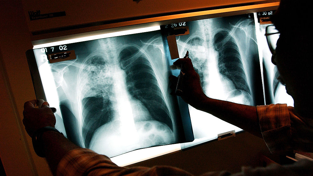 2 active tuberculosis cases traced to San Francisco strip club — KTVU FOX 2 Bay Area, Healdsburg Health news